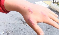 Kedisi elini ısırdı: 'Parmağım düştü' deyip doktora dava açtı