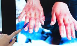 Soğuk ısırığı tehlikesi! Parmak kaybına kadar götürebilir