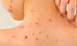 Okullarda suçiçeği salgını! Vakalar patladı...