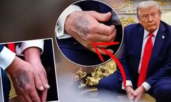 Trump'ın elindeki morlukların sebebi oldu