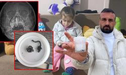 Küçük çocuğun burnundan tırnak makası zinciri çıktı!