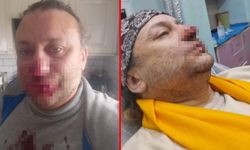 Ünlü şarkıcı Onur Akay'ın yüzü çürümeye başladı! Et yiyen bakteri...