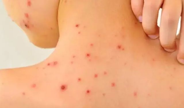 Okullarda suçiçeği salgını! Vakalar patladı...