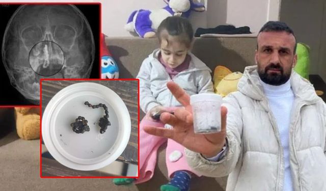 Küçük çocuğun burnundan tırnak makası zinciri çıktı!