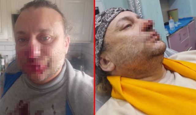 Ünlü şarkıcı Onur Akay'ın yüzü çürümeye başladı! Et yiyen bakteri...
