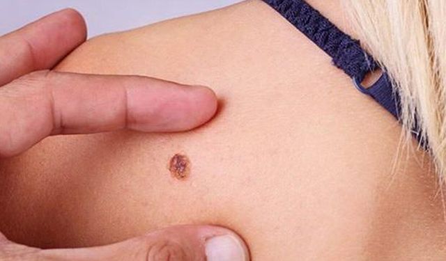 Sıradan leke sanmayın: Cilt kanserinin gizli belirtileri ortaya çıktı