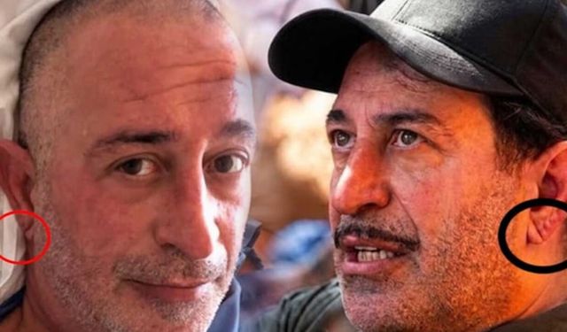 Kulaktaki Frank çizgisi kalp hastalığının habercisi mi? Uzmanından önemli uyarı